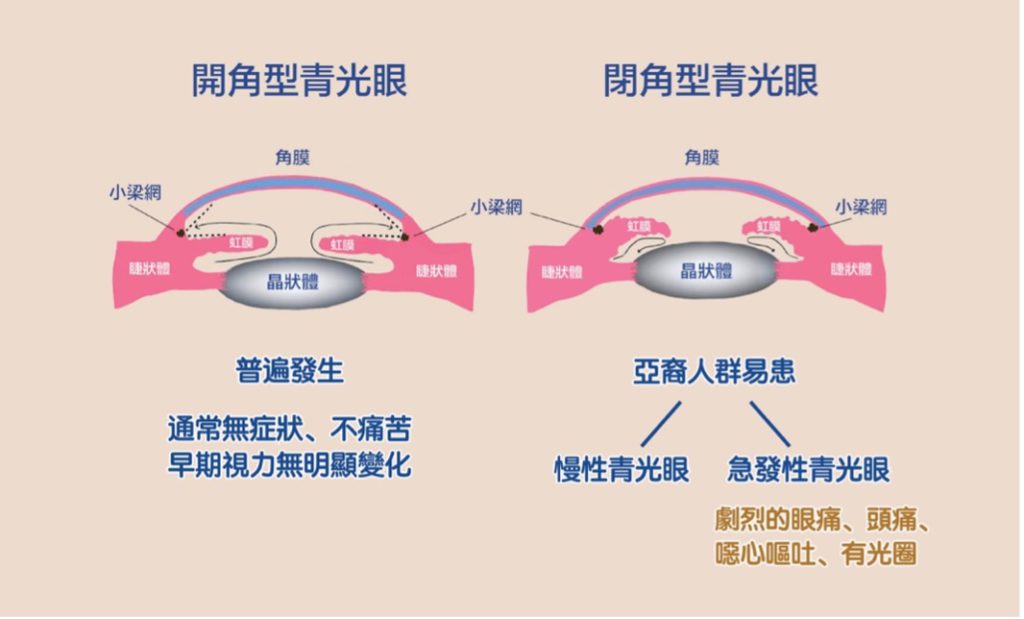 青光眼種類