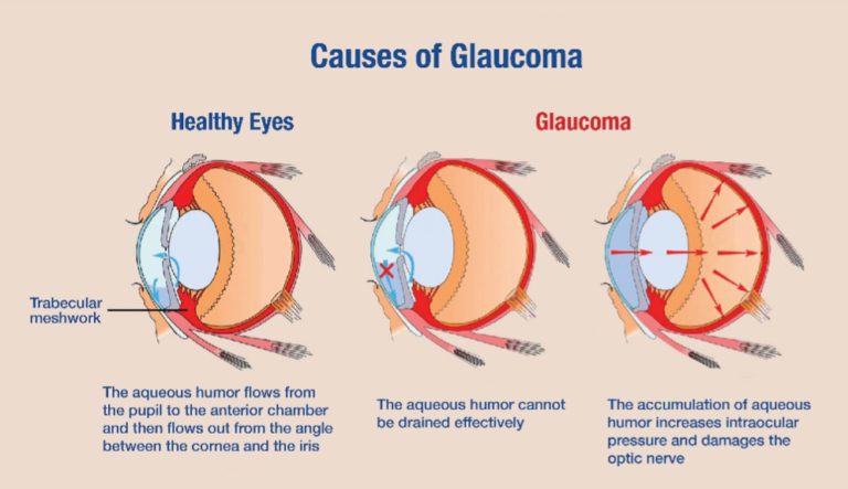 Causes of Glaucoma