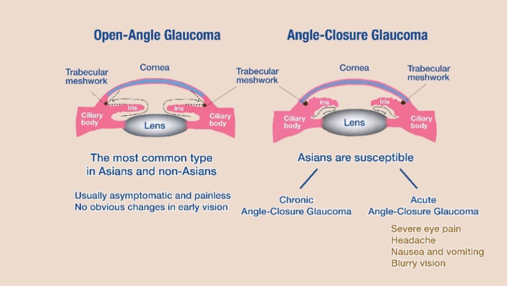 Glaucoma