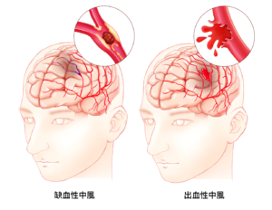 高血壓引發的併發症