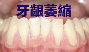 牙齦萎縮