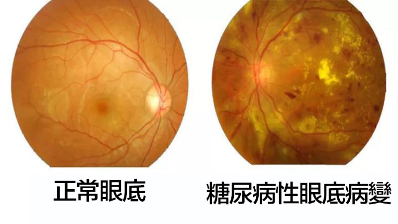 CHAMP 健康月壇 | Diabetic Eyes