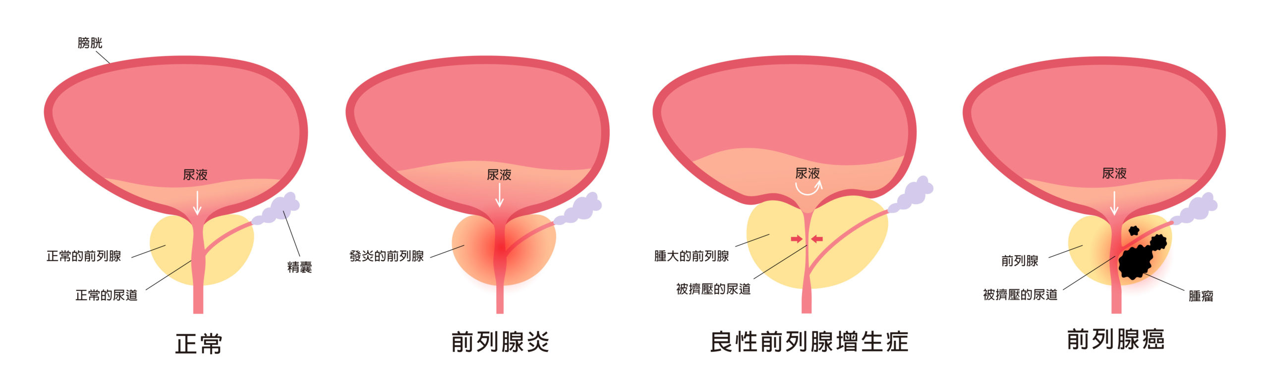 CHAMP 健康月壇 | 前列腺疾病