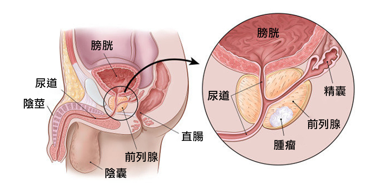 CHAMP 健康月壇 | 前列腺疾病症狀