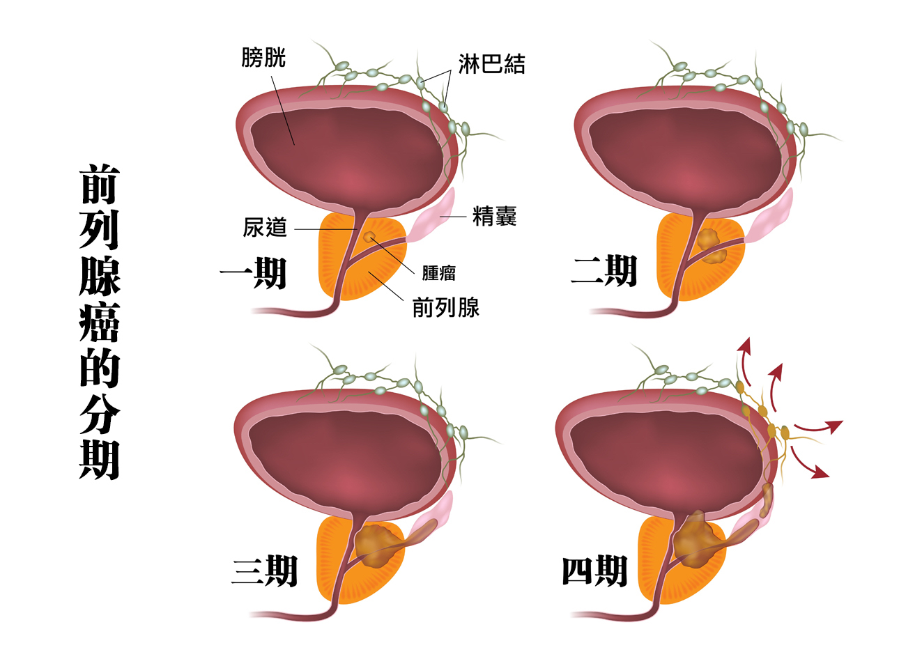 CHAMP 健康月壇 | 前列腺癌的診斷