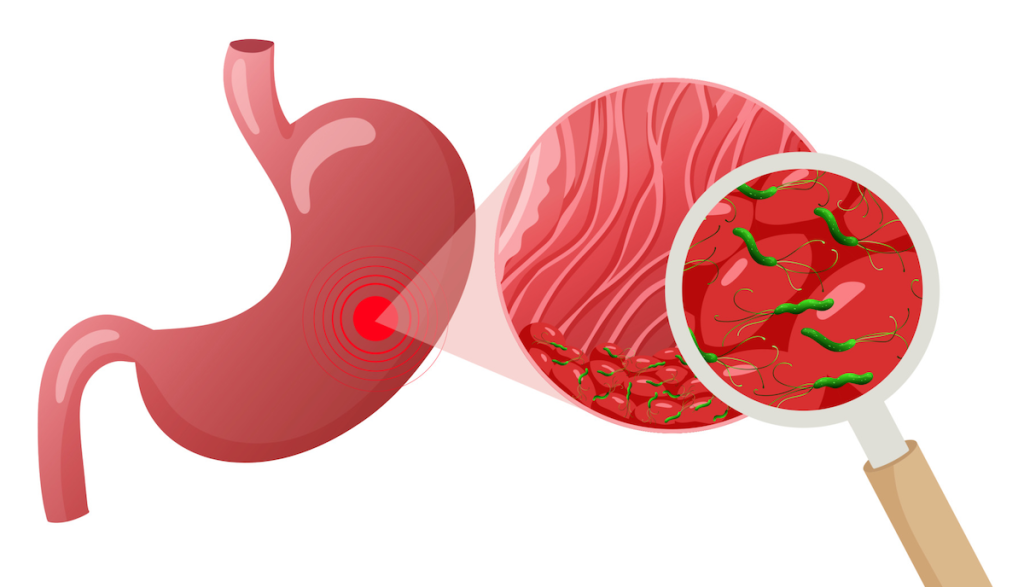 CHAMP 健康月壇 | June Men's Gastrointestinal Health 幽門螺旋桿菌