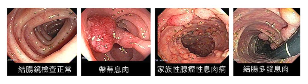 CHAMP 健康月壇 | June Men's Gastrointestinal Health 男性健康