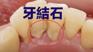 CHAMP 健康月壇 | August Dental Health 牙結石