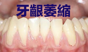 CHAMP 健康月壇 | August Dental Health 牙齦萎縮