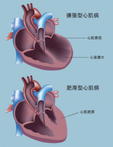CAIPA Health Article - Brief Overview of Cardiomyopathy