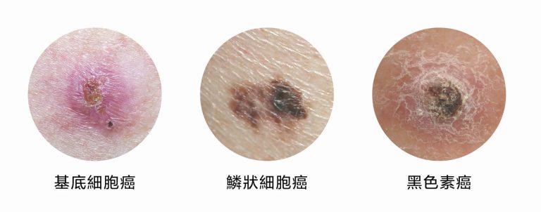 CHAMP Skin Cancer 皮膚癌