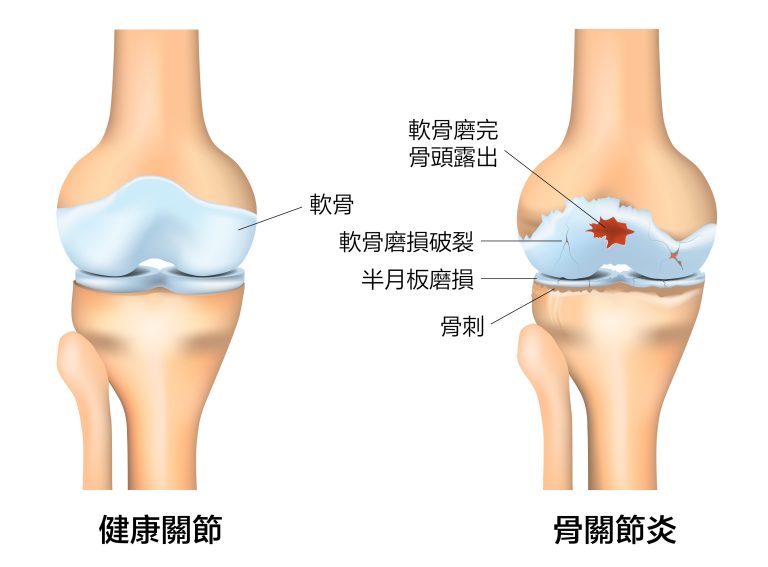 CHAMP - Pain Management 關節疼痛管理