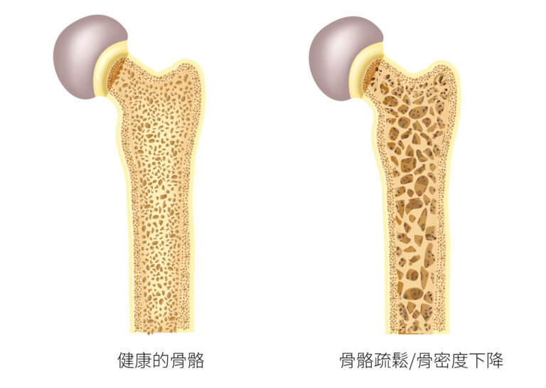 CHAMP - December Osteoporosis 骨質疏松症