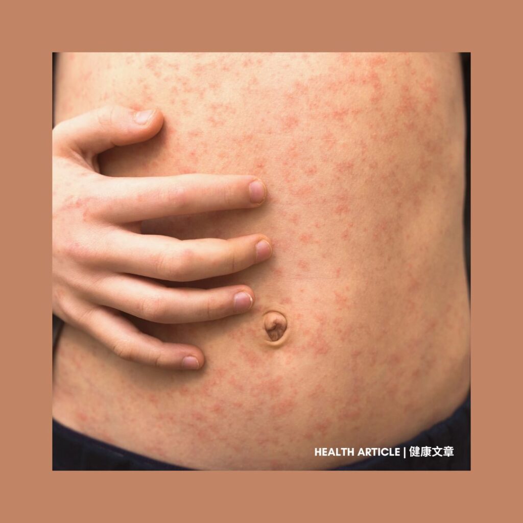 Health Education: Be Aware of the Risk of Measles 麻疹風險需留意