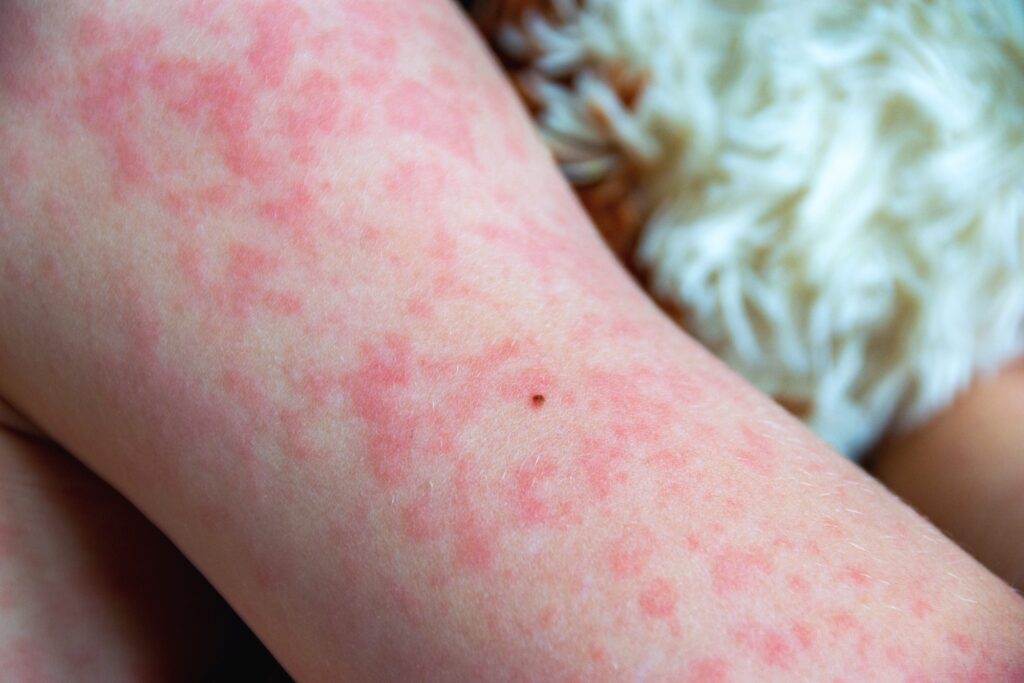 Health Education: Be Aware of the Risk of Measles 麻疹風險需留意
